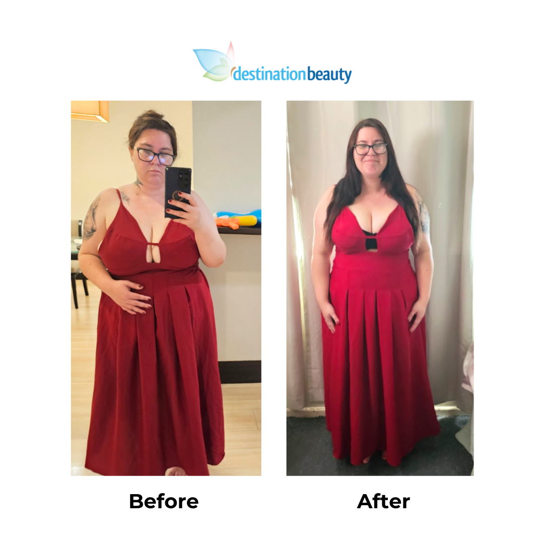 Stafanie Lost 10 Kg After Gastric Sleeve Surgery In Thailand stafanie-lost-10-kg-after-gastric-sleeve-surgery-in-thailand